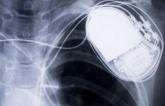 More HF, Worse Long-term Outcomes in TAVI Patients Who Get Pacemakers