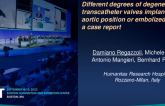 TCT 817: Different degrees of degeneration of transcatheter valves implanted in aortic position or embolized distally: a case report