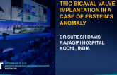 TCT 691: TRIC BICAVAL VALVE IMPLANTATION IN A CASE OF  EBSTEIN'S ANOMALY