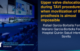 TCT 779: Upper valve dislocation during TAVI procedure: when movilization of the prosthesis is almost impossible