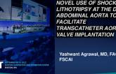 TCT 726: Novel use of shockwave Lithotripsy at the distal abdominal aorta to facilitate transcatheter aortic valve implantation