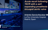 TCT 816: Acute recoil following transcatheter aortic valve replacement with a self-expanding prosthesis in bicuspid aortic valve. 