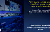 TCT 811: Paravalvular leak as an asset to perform a very complex valve in valve procedure : The case of an uncrossable degenerative bioprosthetic valve.