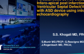 TCT 788: Percutaneous device closure of Infero-apical post Infarction ventricular septal defect (VSD)using Intracardiac echocardiography.