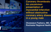 TCT 825: Coronary thrombosis: An uncommon presentation of myocardial infarction without obstructive coronary artery disease in a young male