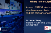 TCT 756: A case of STEMI due to acute simultaneous occlusion of multiple coronary arteries: Where is the culprit? 