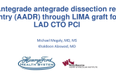 TCT 686: Retrograde CTO PCI through LIMA and LIMA coiling