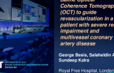 TCT 736: Saline Optical Coherence Tomography (OCT) to guide revascularizationin in a  patient with severe renal impairment and multivessel coronary artery disease.