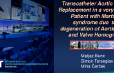 TCT 727: Transcatheter Aortic Valve Replacement in a very young Patient with Marfan syndrome due  to degeneration of Aortic Root and Valve Homograft
