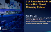 TCT 753: Coil Embolization in an Acute Retroflexed Coronary Fistula