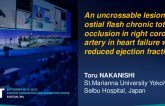 TCT 764: An uncrossable lesion of ostial flash chronic total occlusion in right coronary artery in heart failure with reduced ejection fraction: debulking atherectomy successfully performed to triple vessel disease.