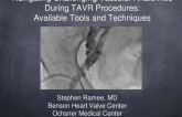 Keynote Lecture: Navigating Challenging Vascular Anatomies During TAVR Procedures: Available Tools and Techniques