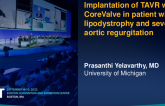 TCT 674: Implantation of TAVR with Corevalve in patient with lipodystrophy and severe aortic regurgitation. 