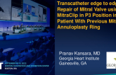 TCT 630: Mitra-clip placement in P3 position in a patient with previous mitral annuloplasty ring