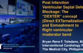 TCT 748: Post Infarction Ventricular Septal Defect Blockage: The "DEXTER" concept (Direct EXTernalization and Emneshment to Right ventricular moderator band)