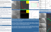 TCT 231: Correlation and Diagnostic Agreement of Quantitative Flow Ratio With Fractional Flow Reserve in Saphenous Vein Grafts