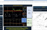 TCT 302: MRR by Continuous Thermodilution is not Influenced by the Ray Flow Catheter Effect on Coronary Resistance