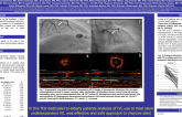 TCT 188: Safety and Efficacy of Intravascular Lithotripsy in the Management of Stent Undeexpansion Among Elderly Patients