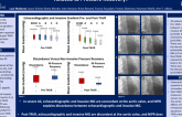 TCT 367: Is Discordance Between Echocardiography and Invasive Trans Aortic Valve Mean Gradients Related to Pressure Recovery?