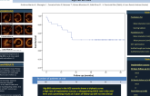 TCT 63: Long-term Outcomes of bioabsorbable magnesium scaffold in acute coronary syndromes