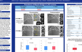 TCT 288: Myocardial bridge is more common in LAD-CTOs than non-CTO LAD stenoses.