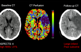 Stroke Thrombectomy May Work for Large Infarcts in the Late Time Window 