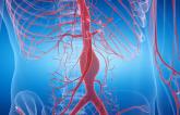 ACC/AHA Release Updated Aortic Disease Guideline