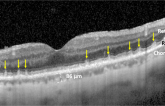 Age-Related Macular Degeneration Linked to Severe Vascular Disease