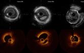 Intravascular Imaging to Inform PCI Should Be Routine: ACC Interventional Council 