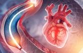 Long-term Data Support Paclitaxel-Coated Balloons for In-Stent Restenosis