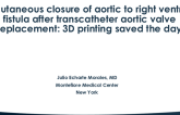 Percutaneous Closure of Aortic to Right Ventricle Fistula After Transcatheter Aortic Valve Replacement: 3D Printing Saved the Day