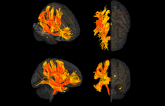 Brain Areas Identified Linking High BP and Cognitive Impairment