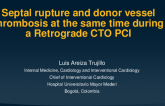 Septal Rupture and Donor Vessel Thrombosis at the same time During a Retrograde CTO PCI