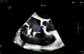 Higher Gradient After Tricuspid TEER Not Harmful at 1 Year: TriValve Registry