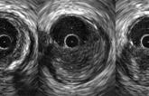 For Complex PCI, Intravascular Imaging Lowers Risk of Target Vessel Failure  