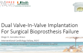 Dual Valve-In-Valve Implantation For Surgical Bioprosthesis Failure