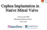 Cephea Implantation in Native Mitral Valve
