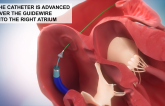 No-Implant Shunt for HF Looks Safe, Feasible in Early Snapshot