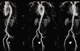 Cardiac MR Noninferior to CT for TAVI Planning, Small RCT Shows