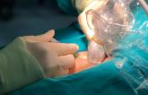 Ultrasound Cuts Vascular Complications, Bleeds in Transfemoral Access
