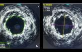 Intravascular Imaging Lowers Risk of MACE at 1 Year in Left Main PCI
