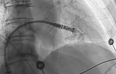 Micra Leadless Pacemaker Performs Well Through 5 Years