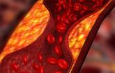 Atherosclerosis Progression May Share Traits With Tumor Growth
