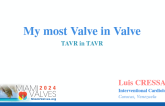 My most Valve in Valve TAVR in TAVR