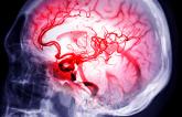 RAISE: Reteplase May Be Another Option for Stroke Thrombolysis