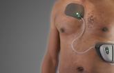 Patch May Prevail Where Prior Wearable Defibrillators Faltered: Jewel IDE Study