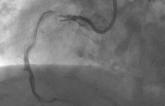 DES Best for In-Stent Restenosis, but DCBs Also Viable