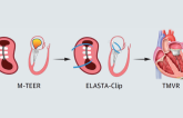 ELASTA-Clip Plus TMVR Safe, Feasible for Failed M-TEER