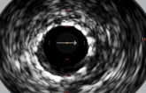 Intravascular Imaging During PCI Should Be a Performance Metric, Researchers Say
