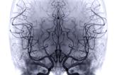 Lower Diagnostic Success With Transradial Cerebral Angiography